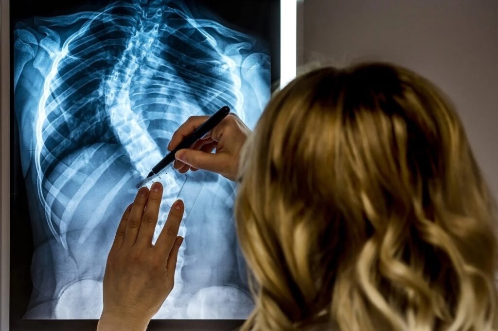X-ray Scoliosis