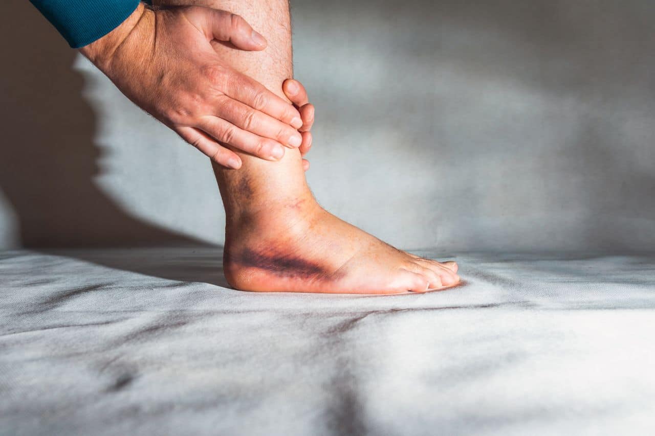 ankle sprain treatment in vancouver